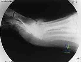 صورة توضيحية لـ علاج تصلب إبهام القدم جراحياً: كل ما تحتاج معرفته عن استئصال النتوء العظمي الظهري مع الأستاذ الدكتور محمد هطيف