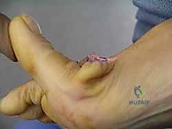 صورة توضيحية لـ علاج تصلب إبهام القدم جراحياً: كل ما تحتاج معرفته عن استئصال النتوء العظمي الظهري مع الأستاذ الدكتور محمد هطيف