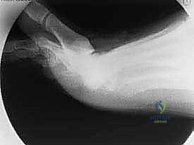 صورة توضيحية لـ علاج تصلب إبهام القدم جراحياً: كل ما تحتاج معرفته عن استئصال النتوء العظمي الظهري مع الأستاذ الدكتور محمد هطيف