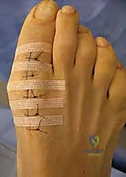 صورة توضيحية لـ علاج تصلب إبهام القدم جراحياً: كل ما تحتاج معرفته عن استئصال النتوء العظمي الظهري مع الأستاذ الدكتور محمد هطيف