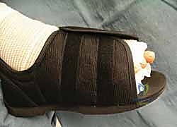 صورة توضيحية لـ علاج تصلب إبهام القدم جراحياً: كل ما تحتاج معرفته عن استئصال النتوء العظمي الظهري مع الأستاذ الدكتور محمد هطيف