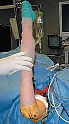 استخراج الأجسام الحرة بالمنظار