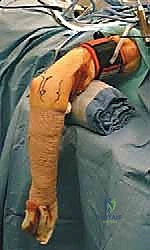 تقنيات منظار الكوع المتقدمة