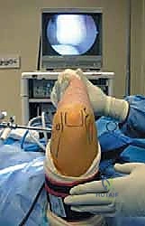 علاج خشونة مفصل الكوع