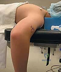 تشخيص أعراض الكوع