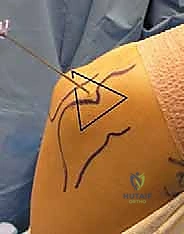 التصوير الطبي لتشخيص الكوع