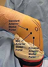 التجهيز لعملية منظار الكوع