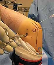 إنشاء بوابات منظار الكوع