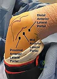 صورة توضيحية لـ منظار مفصل الكوع: دليل شامل للمرضى والعلاج مع الأستاذ الدكتور محمد هطيف في صنعاء