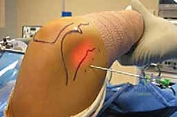 صورة توضيحية لـ منظار مفصل الكوع: دليل شامل للمرضى والعلاج مع الأستاذ الدكتور محمد هطيف في صنعاء