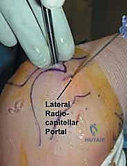 Illustration of portal dual cannula - Dr. Mohammed Hutaif