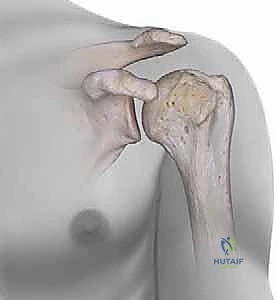 صورة توضيحية لـ تثبيت كسور عظم العضد القريب بالمسامير النخاعية: دليل شامل للمرضى مع الأستاذ الدكتور محمد هطيف