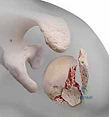 صورة توضيحية لتصنيف نير للكسور