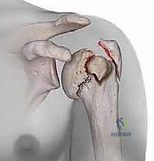 صورة توضيحية توضح تقييم الأشعة السينية لكسور العضد