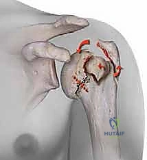 صورة توضيحية للتشريح الطبيعي للكتف، مع إظهار رأس العضد، الحدبتين، ومحاذاة العظم