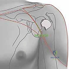 صورة توضيحية لتحديد نقطة الدخول في رأس العضد