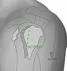 صورة توضيحية لإدخال السلك الدليلي