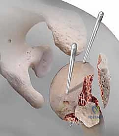 صورة توضيحية للتثبيت البعيد بالبراغي