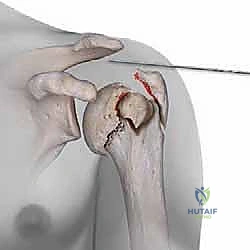 صورة توضيحية لإدخال المسمار النخاعي