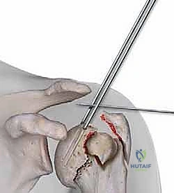 صورة توضيحية للتثبيت القريب بالبراغي