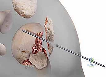صورة توضيحية لعملية التوسيع النخاعي