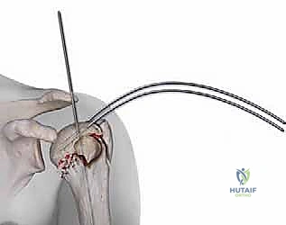 صورة توضيحية لـ تثبيت كسور عظم العضد القريب بالمسامير النخاعية: دليل شامل للمرضى مع الأستاذ الدكتور محمد هطيف