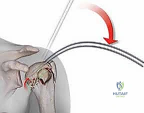 صورة توضيحية لـ تثبيت كسور عظم العضد القريب بالمسامير النخاعية: دليل شامل للمرضى مع الأستاذ الدكتور محمد هطيف