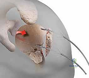 صورة توضيحية لـ تثبيت كسور عظم العضد القريب بالمسامير النخاعية: دليل شامل للمرضى مع الأستاذ الدكتور محمد هطيف