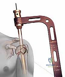 صورة توضيحية لـ تثبيت كسور عظم العضد القريب بالمسامير النخاعية: دليل شامل للمرضى مع الأستاذ الدكتور محمد هطيف