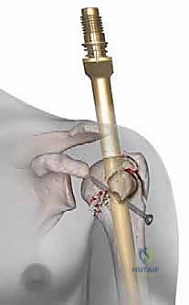 صورة توضيحية لـ تثبيت كسور عظم العضد القريب بالمسامير النخاعية: دليل شامل للمرضى مع الأستاذ الدكتور محمد هطيف