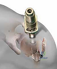 صورة توضيحية لـ تثبيت كسور عظم العضد القريب بالمسامير النخاعية: دليل شامل للمرضى مع الأستاذ الدكتور محمد هطيف