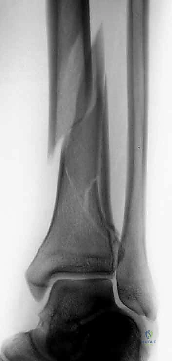 آلية الإصابة وتأثير القوة المحورية على الكاحل