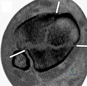 تفاصيل تشريحية دقيقة لمفصل الكاحل وعظم الظنبوب