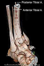 رسم توضيحي لأنواع كسور البيلون وتصنيفاتها