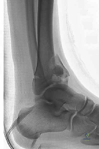 صورة شعاعية أخرى توضح التفتت الشديد