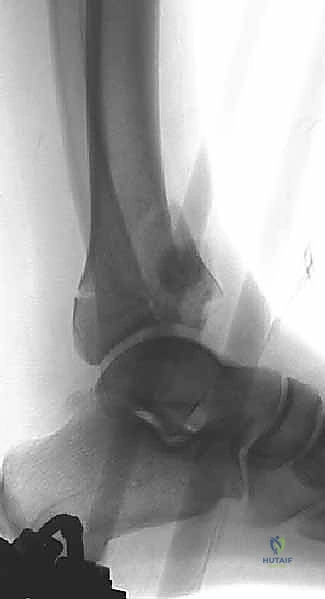 مرحلة الإدارة المرحلية باستخدام المثبت الخارجي المؤقت