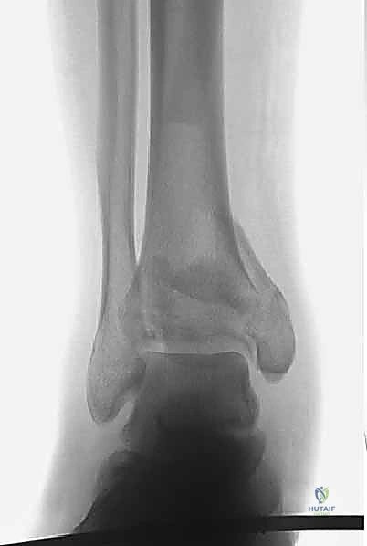 مقطع عرضي في الأشعة المقطعية يوضح القطع العظمية المفصلية