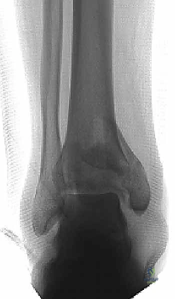 الأشعة السينية الأولية تظهر تفتت المفصل