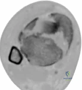 صورة طبية: كسر البيلون ORIF: إعادة بناء مفصل الكاحل بدقة متناهية مع الأستاذ الدكتور محمد هطيف في صنعاء