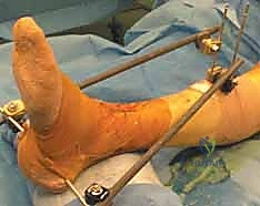 تصوير مقطعي محوسب CT يظهر تفاصيل الكسر ثلاثية الأبعاد