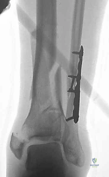 صورة طبية: كسر البيلون ORIF: إعادة بناء مفصل الكاحل بدقة متناهية مع الأستاذ الدكتور محمد هطيف في صنعاء