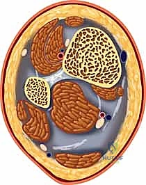 صورة طبية: كسر البيلون ORIF: إعادة بناء مفصل الكاحل بدقة متناهية مع الأستاذ الدكتور محمد هطيف في صنعاء