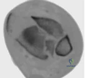 صورة طبية: كسر البيلون ORIF: إعادة بناء مفصل الكاحل بدقة متناهية مع الأستاذ الدكتور محمد هطيف في صنعاء