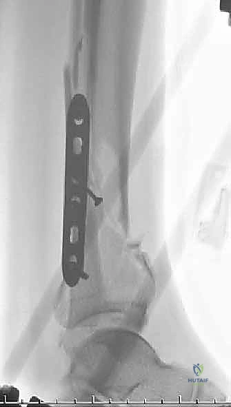 صورة للمثبت الخارجي يمتد عبر الكاحل لتقليل التورم