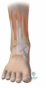 صورة طبية: كسر البيلون ORIF: إعادة بناء مفصل الكاحل بدقة متناهية مع الأستاذ الدكتور محمد هطيف في صنعاء