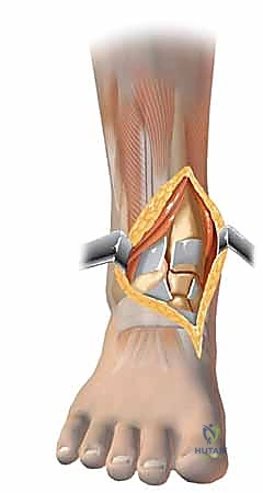 صورة طبية: كسر البيلون ORIF: إعادة بناء مفصل الكاحل بدقة متناهية مع الأستاذ الدكتور محمد هطيف في صنعاء