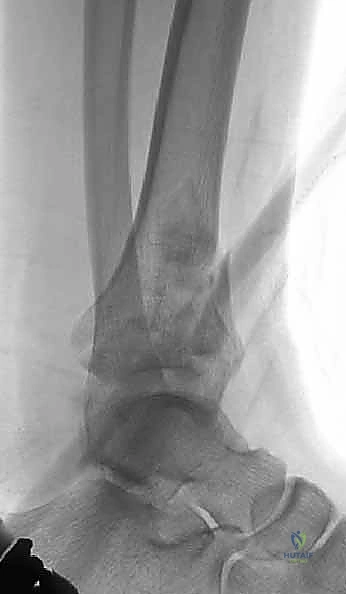 صورة توضيحية لـ كسر البيلون ORIF: إعادة بناء مفصل الكاحل بدقة متناهية مع الأستاذ الدكتور محمد هطيف في صنعاء