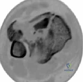 صورة طبية: كسر البيلون ORIF: إعادة بناء مفصل الكاحل بدقة متناهية مع الأستاذ الدكتور محمد هطيف في صنعاء