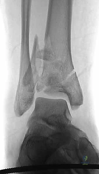 صورة توضيحية لـ كسر البيلون ORIF: إعادة بناء مفصل الكاحل بدقة متناهية مع الأستاذ الدكتور محمد هطيف في صنعاء