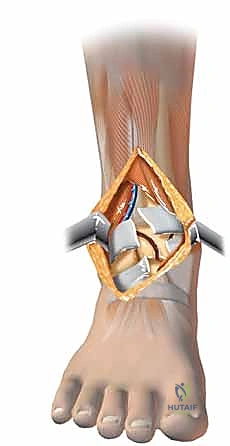 صورة طبية: كسر البيلون ORIF: إعادة بناء مفصل الكاحل بدقة متناهية مع الأستاذ الدكتور محمد هطيف في صنعاء